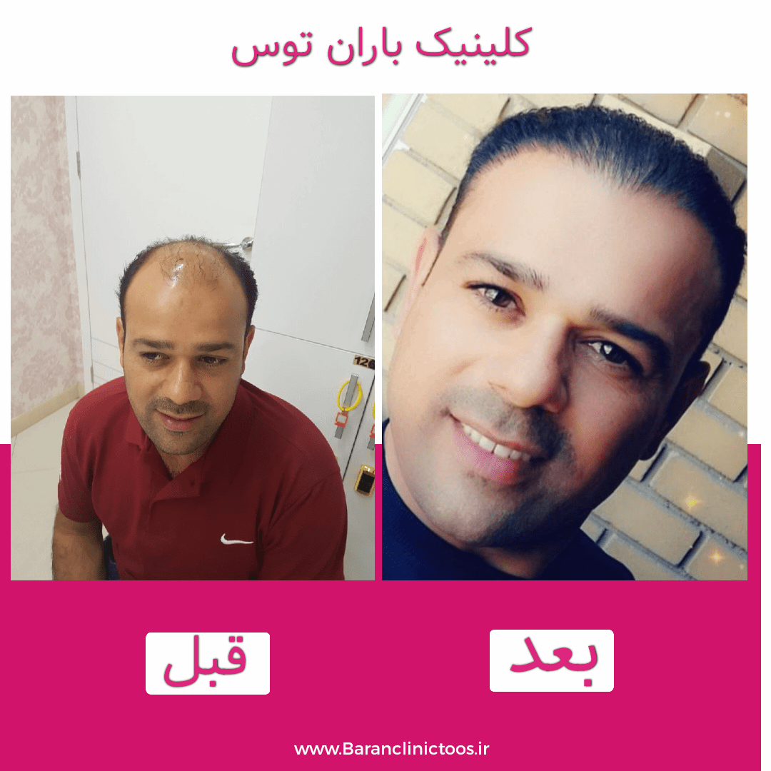 قبل و بعد کاشت مو